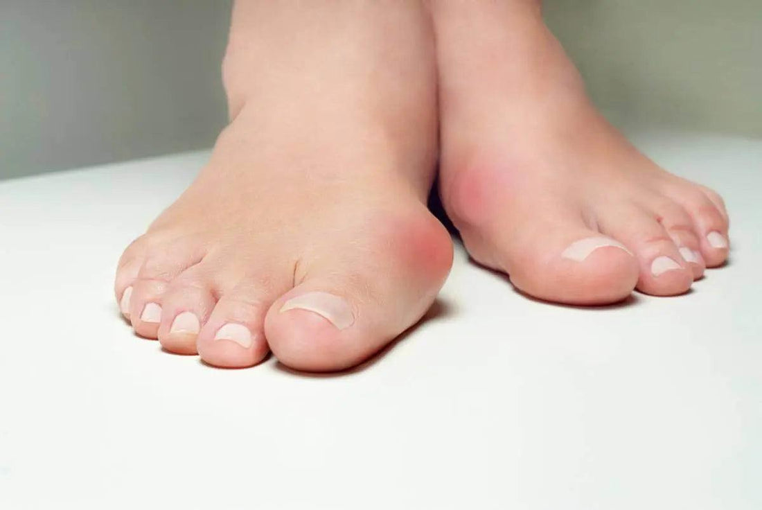 3 options de soulagement non chirurgical pour les oignons - Confort Orthopédique