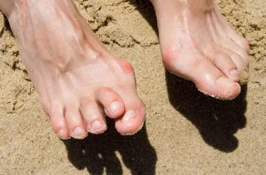 Comment soulager la douleur des oignons et des orteils en marteau ? - Confort Orthopédique