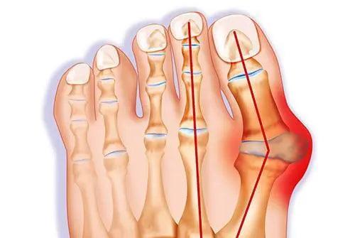 Sandales pour oignons : soulager la douleur des oignons sans chirurgie - Confort Orthopédique