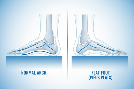 Pieds plats : 12 conseils d'experts pour optimiser votre confort