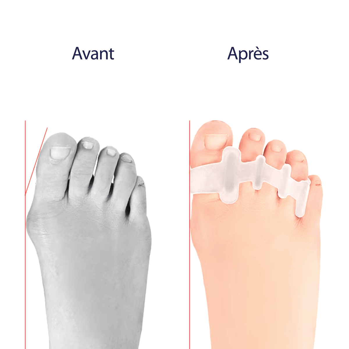 Orthèse orteil en griffe - Confort Orthopédique