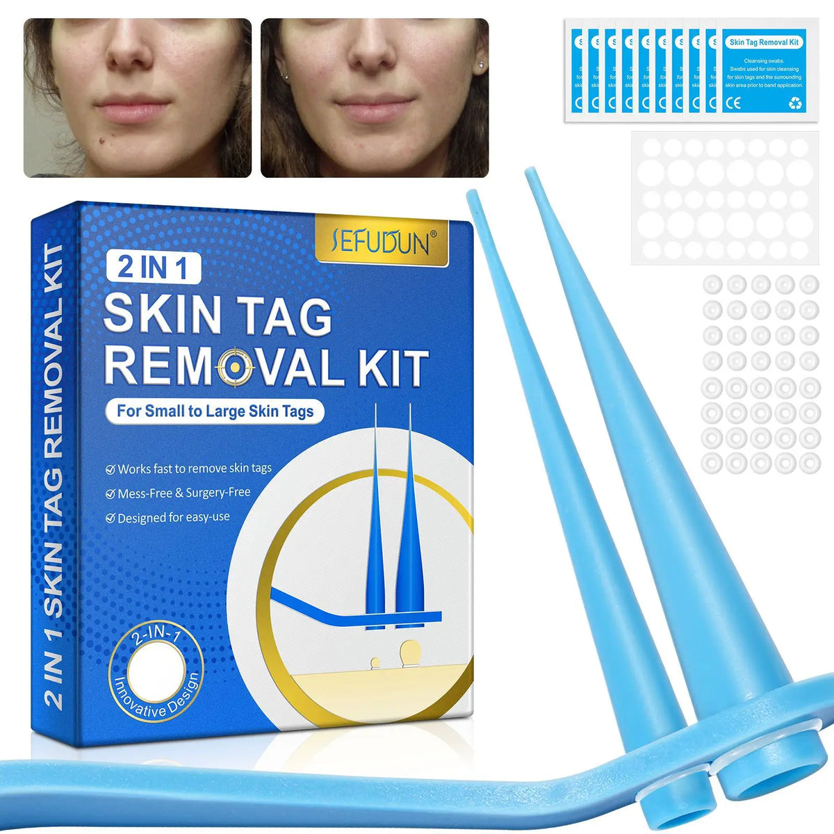 Kit 2-en-1 pour l'élimination des verrues et des excroissances cutanées sans douleur