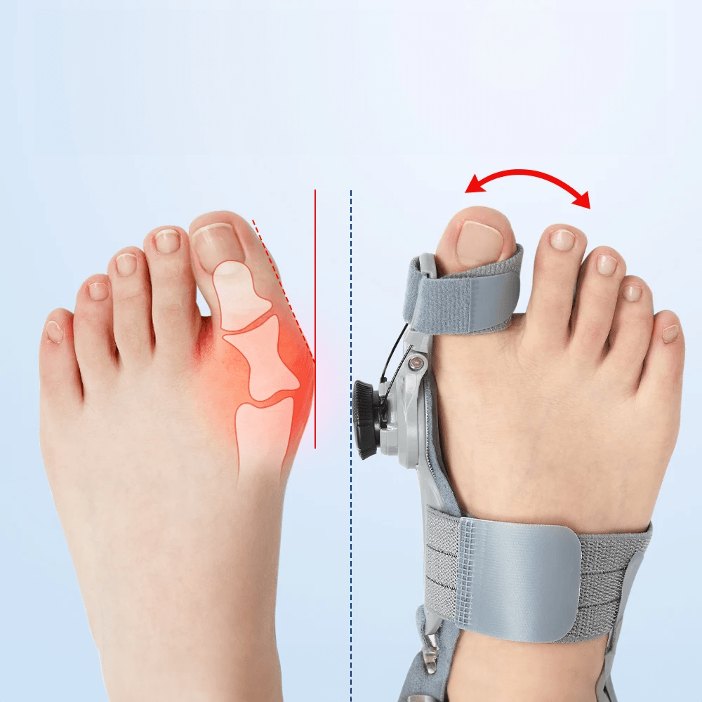 Attelle hallux valgus réglable - Confort Orthopédique