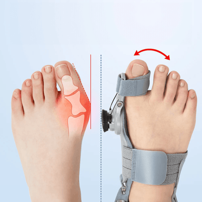 Attelle hallux valgus réglable - Confort Orthopédique