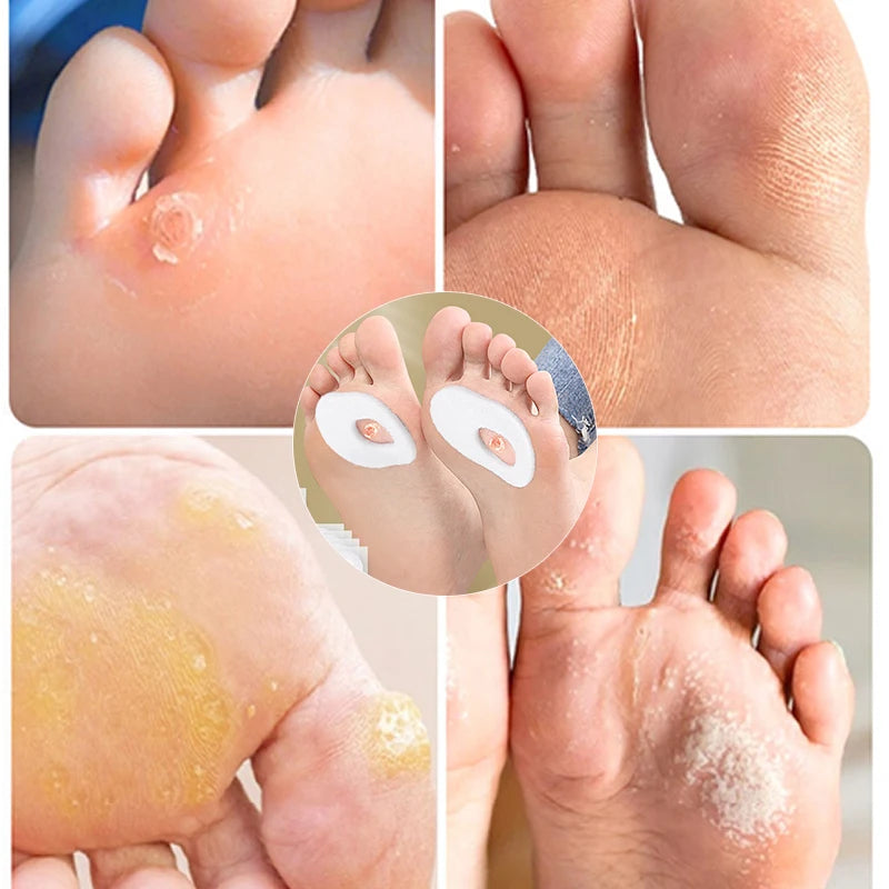 6 autocollants/feuille pour les callosités des pieds, patchs anti verrue