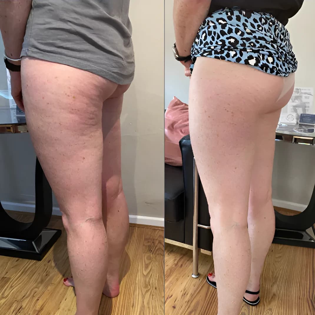 Résultats avant et après l'utilisation de l'appareil de massage anti-cellulite corporel sur les cuisses, montrant une peau plus lisse et tonique.