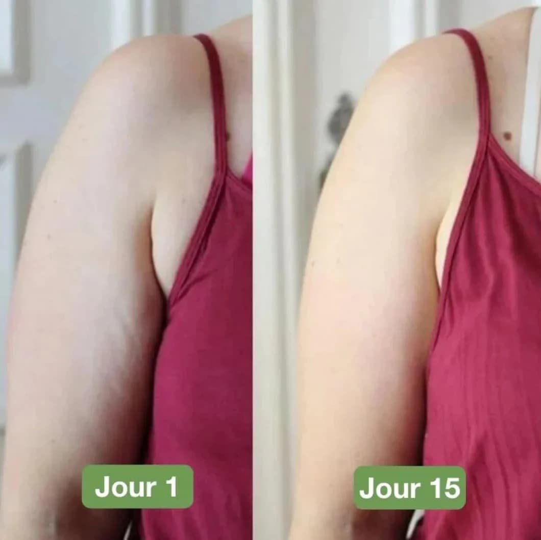 Comparaison de l'effet de l'appareil de massage anti-cellulite sur le bras, montrant une amélioration visible entre le jour 1 et le jour 15.