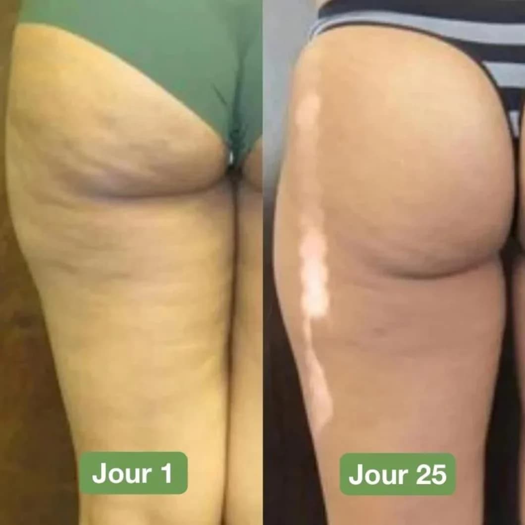 Résultats avant et après l'utilisation de l'appareil de massage anti-cellulite corporel sur les cuisses, montrant une peau plus lisse.