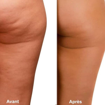 Appareil de massage anti-cellulite moderne à ventouse – Résultats avant et après sur la peau avec réduction visible de la cellulite